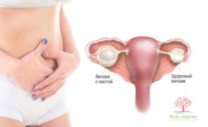 Медикаментозный аборт при кисте яичника