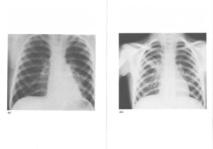 Перибронхиальный отек