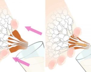 Лактостаз после перетягивания груди