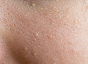 Мелкие бесцветные пупырышки на коже зимой их нет