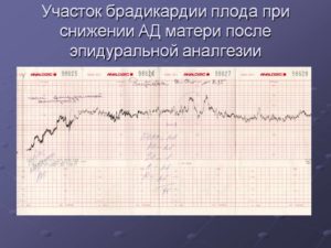 Брадикардия плода