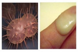 Инфекция на головке члена