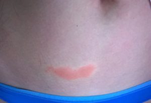 Красные пятна внизу живота у ребенка