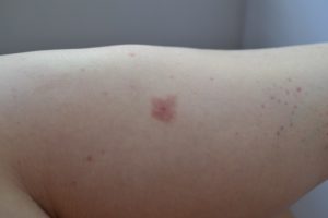 Красно-бордовые пятна на ногах