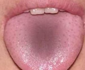 Хронический гастрит и белый налёт на языке