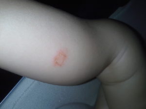 Болячка у ребенка