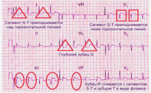 Инфаркт миокарда при нормальном давлении и пульсе