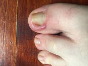 Боль в пальце через несколько дней после удаления ногтя