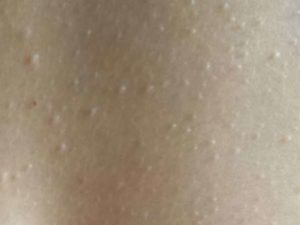 Мелкие бесцветные пупырышки на коже зимой их нет