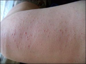 Красная сыпь после душа