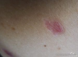 Красное пятно после удаления родинки лазером