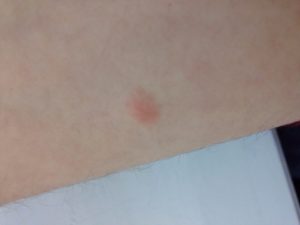 Красные, круглые пятна на руке, небольшие