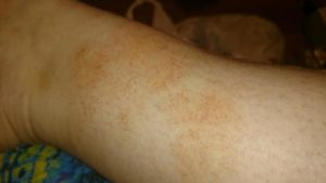 Коричневые пятна на икрах ног